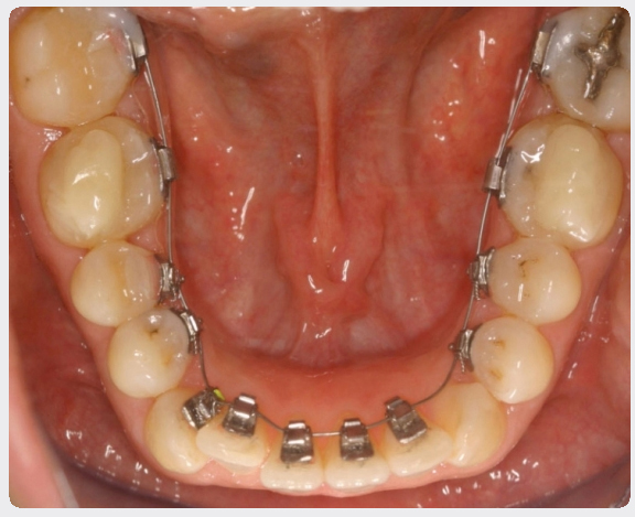 aparat dentar stb